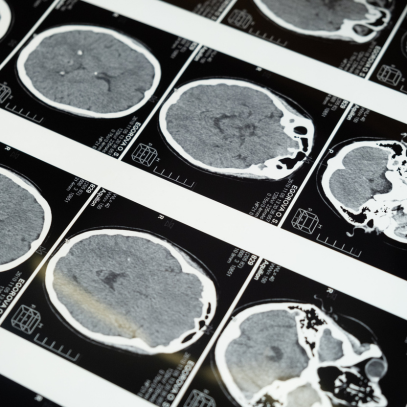 Kratom and the Neuro ICU